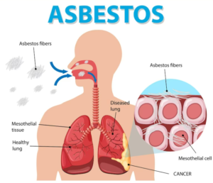 2023-02-09 15_27_06-Diagram met asbestose in de longen _ Gratis Vector